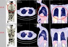 台灣細胞治療技術展現新希望 跨國癌症患者肯定臨床成果 台灣細胞治療技術展現新希望 跨國癌症患者肯定臨床成果